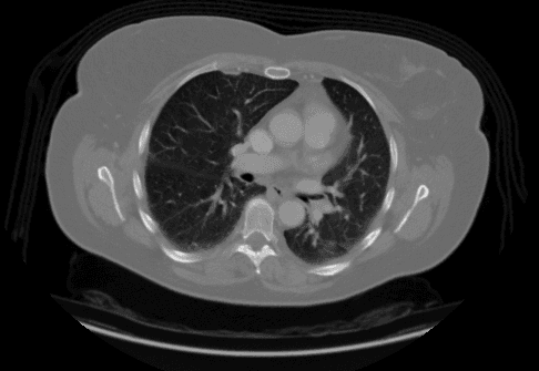 Adenocarcinoma Lung Cancer Image